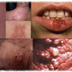 Illustration for article titled Obat Penyakit Herpes